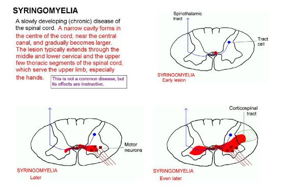 syringomyelia spinal cord