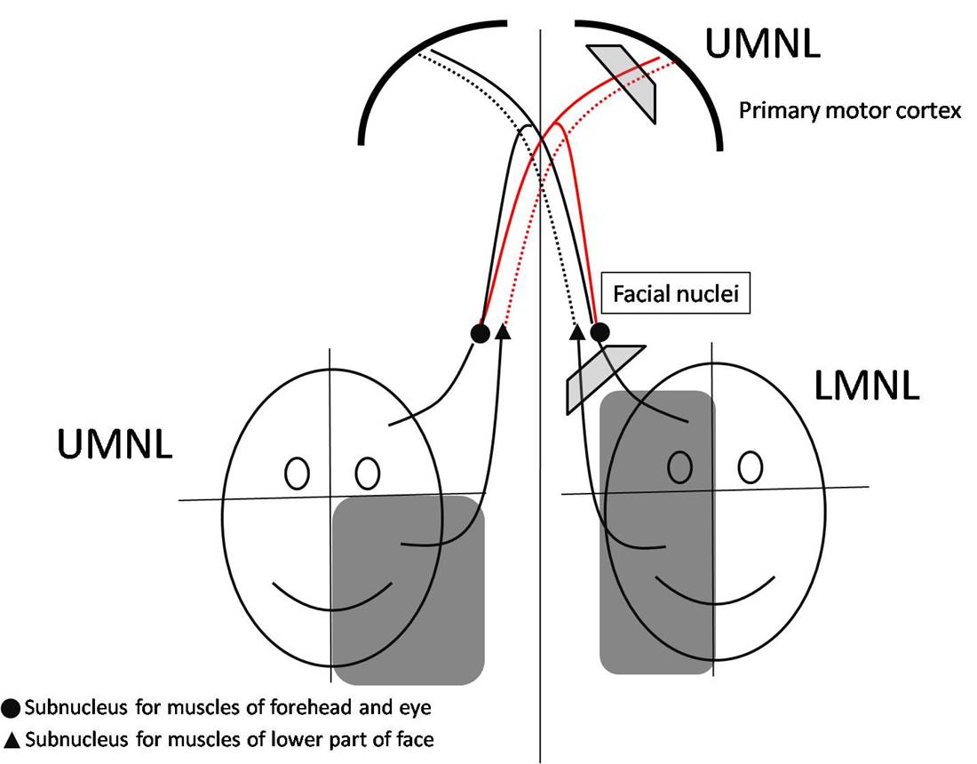 facial nerve palsy pathway