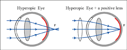 Hyperopic Eye